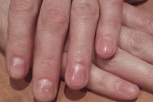 5 заболеваний, о которых могут рассказать ногти