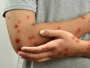 Вирусологи обнаружили новый штамм вируса у человека, вернувшегося из Азии Вирусологи обнаружили новый штамм вируса у человека, вернувшегося из Азии